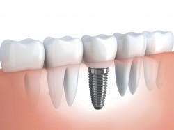 dental implants and other prosthodontic services by crabtree dental office in katy tx